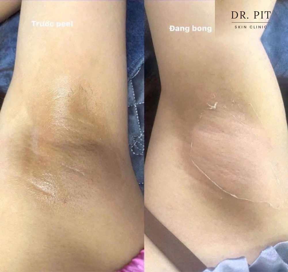 Vùng da trước khi peel và trong giai đoạn bong da